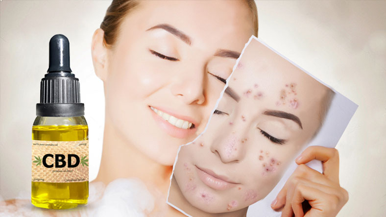CBD For acne