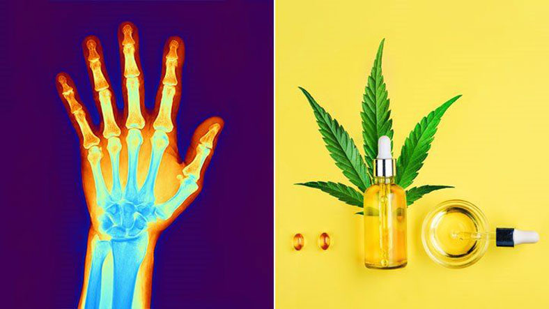 CBD for the treatment of arthritis